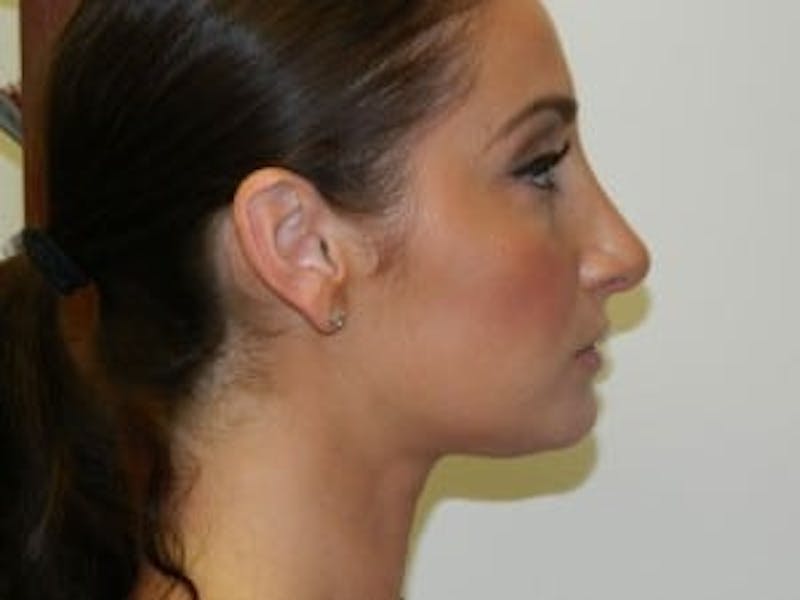 Rhinoplasty Before & After Gallery - Patient 133066697 - Image 4