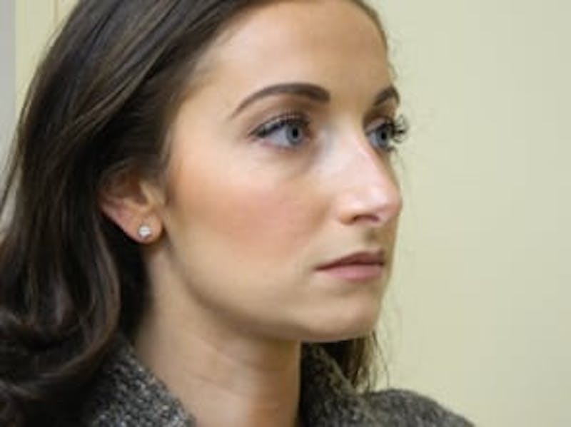 Rhinoplasty Before & After Gallery - Patient 133066697 - Image 5