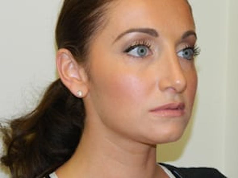 Rhinoplasty Before & After Gallery - Patient 133066697 - Image 6