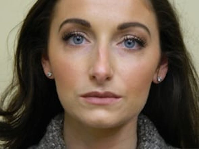 Rhinoplasty Before & After Gallery - Patient 133066697 - Image 7