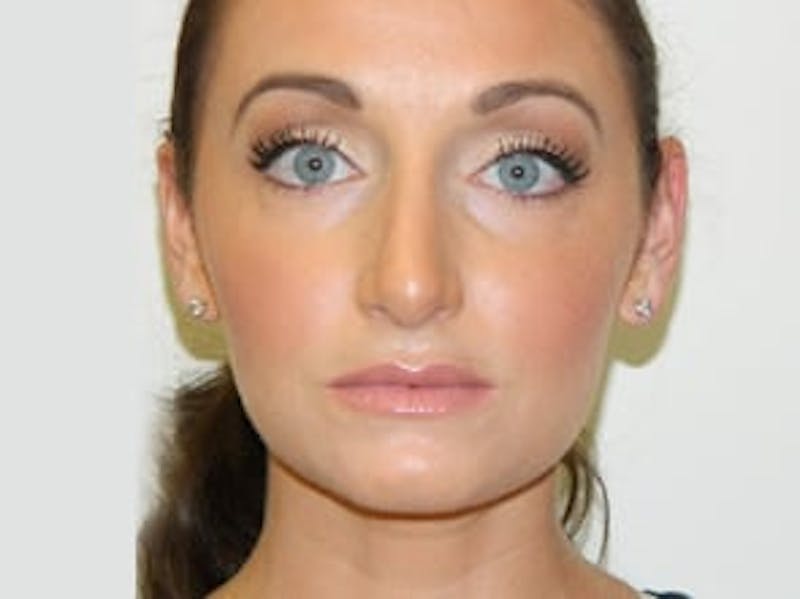 Rhinoplasty Before & After Gallery - Patient 133066697 - Image 8