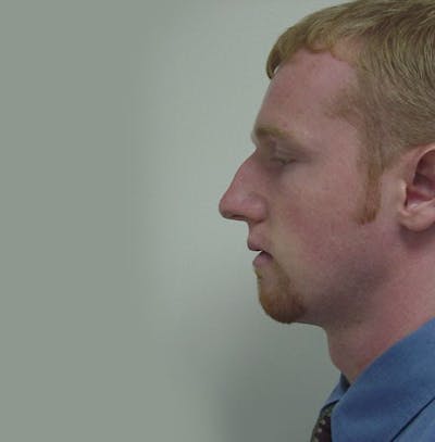 Rhinoplasty Before & After Gallery - Patient 133066698 - Image 1