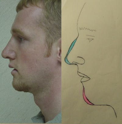 Rhinoplasty Before & After Gallery - Patient 133066698 - Image 2