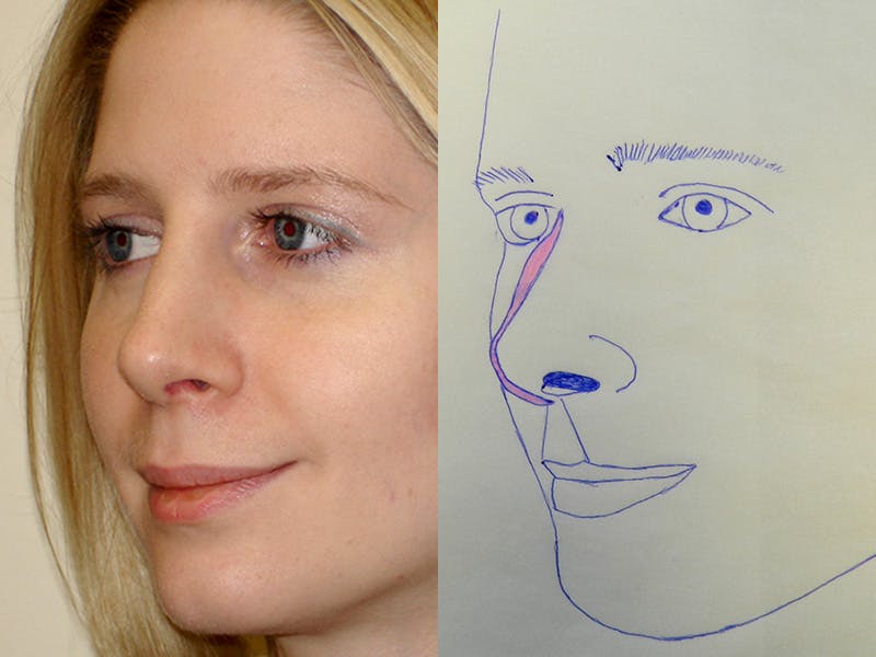 Rhinoplasty Before & After Gallery - Patient 133066700 - Image 2
