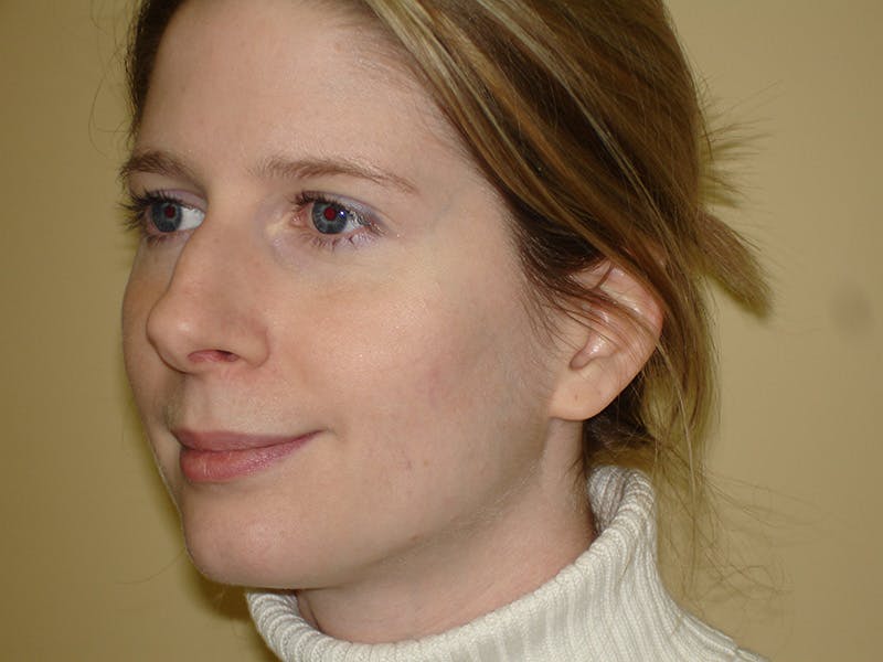 Rhinoplasty Before & After Gallery - Patient 133066700 - Image 3