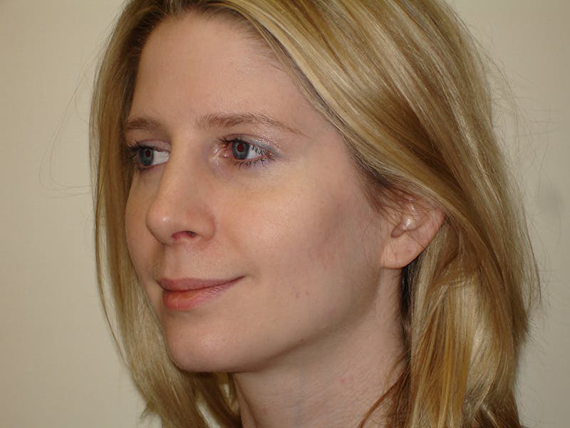 Rhinoplasty Before & After Gallery - Patient 133066700 - Image 4