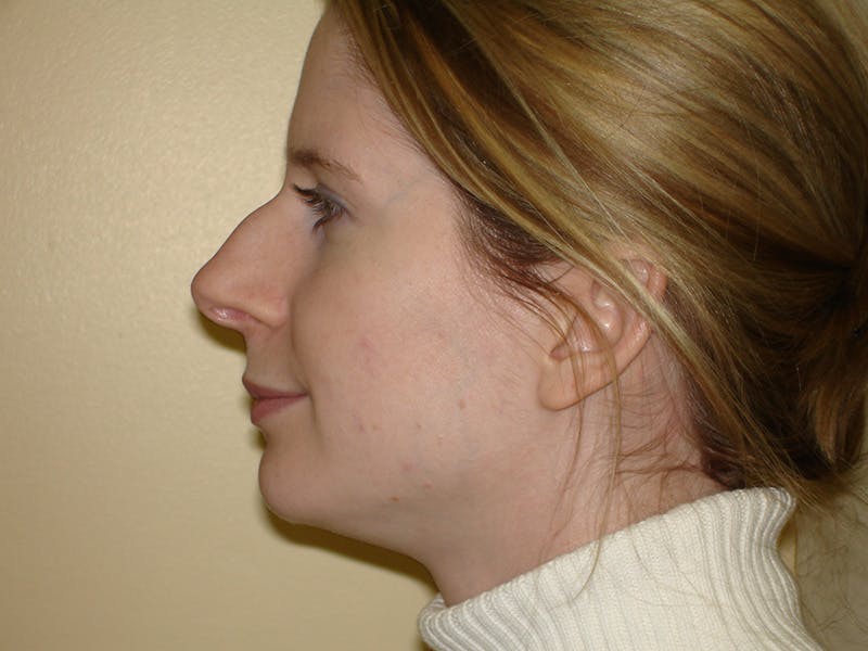 Rhinoplasty Before & After Gallery - Patient 133066700 - Image 5