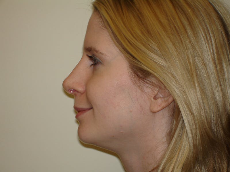 Rhinoplasty Before & After Gallery - Patient 133066700 - Image 6