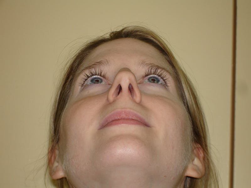 Rhinoplasty Before & After Gallery - Patient 133066700 - Image 7