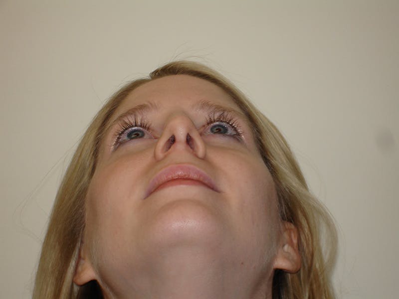 Rhinoplasty Before & After Gallery - Patient 133066700 - Image 8