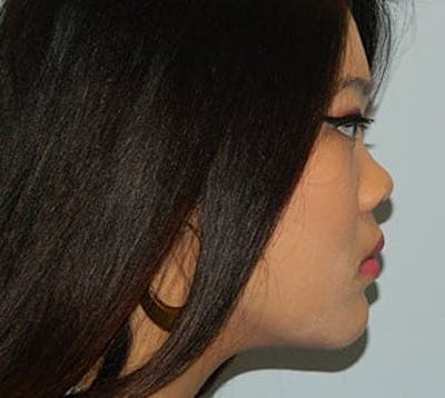 Rhinoplasty Before & After Gallery - Patient 133066701 - Image 1