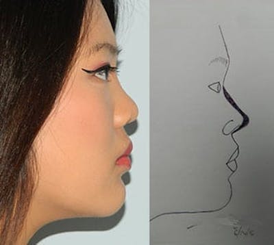 Rhinoplasty Before & After Gallery - Patient 133066701 - Image 2