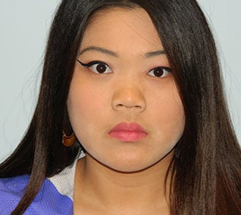 Rhinoplasty Before & After Gallery - Patient 133066701 - Image 3