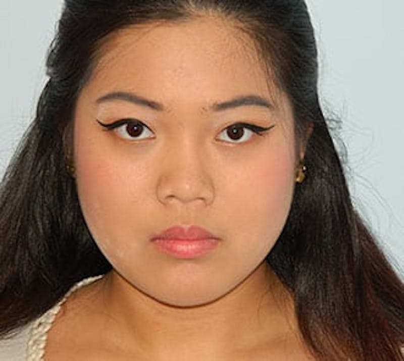 Rhinoplasty Before & After Gallery - Patient 133066701 - Image 4