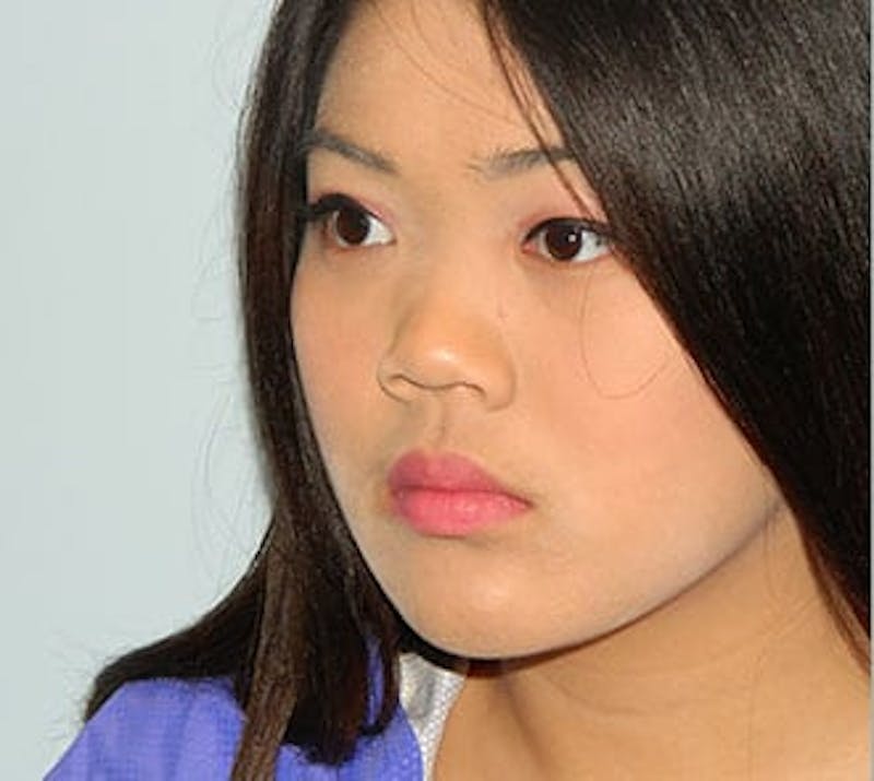Rhinoplasty Before & After Gallery - Patient 133066701 - Image 5