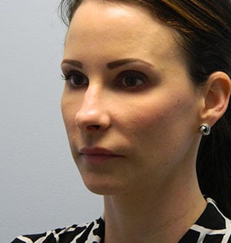 Rhinoplasty Before & After Gallery - Patient 133066702 - Image 3