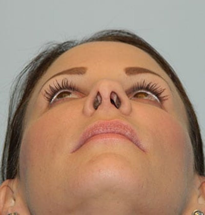 Rhinoplasty Before & After Gallery - Patient 133066702 - Image 5