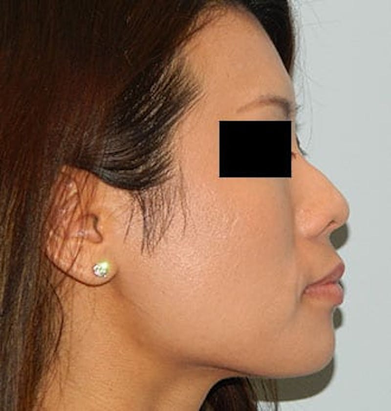 Rhinoplasty Before & After Gallery - Patient 133066703 - Image 1