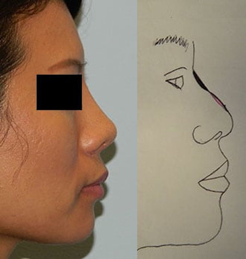 Rhinoplasty Before & After Gallery - Patient 133066703 - Image 2