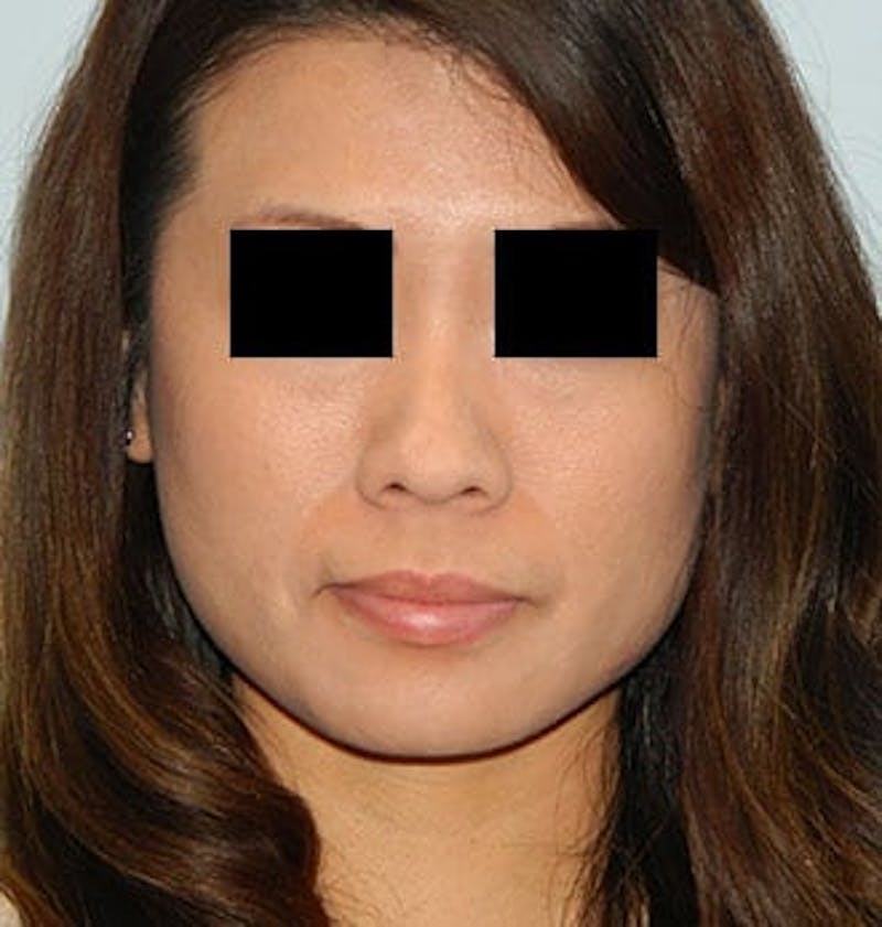 Rhinoplasty Before & After Gallery - Patient 133066703 - Image 3