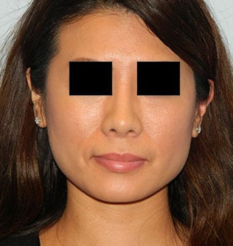 Rhinoplasty Before & After Gallery - Patient 133066703 - Image 4