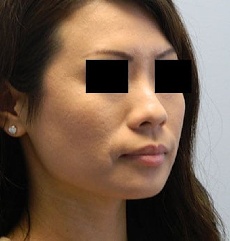 Rhinoplasty Before & After Gallery - Patient 133066703 - Image 5