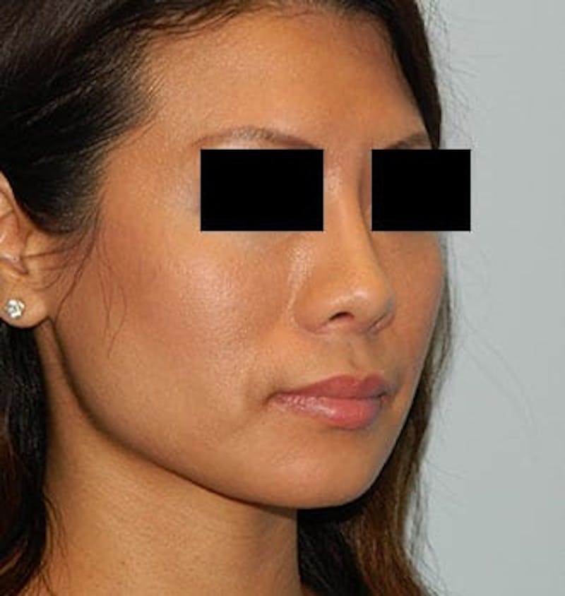 Rhinoplasty Before & After Gallery - Patient 133066703 - Image 6