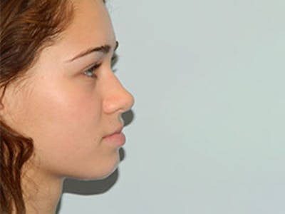 Rhinoplasty Before & After Gallery - Patient 133066706 - Image 1