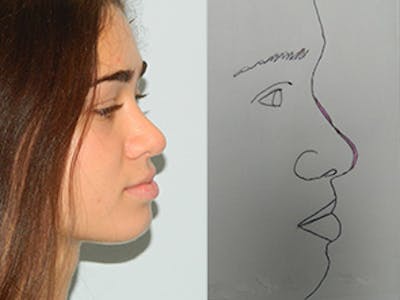 Rhinoplasty Before & After Gallery - Patient 133066706 - Image 2