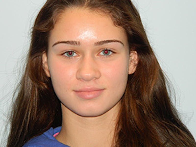 Rhinoplasty Before & After Gallery - Patient 133066706 - Image 3