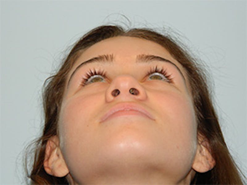 Rhinoplasty Before & After Gallery - Patient 133066706 - Image 5