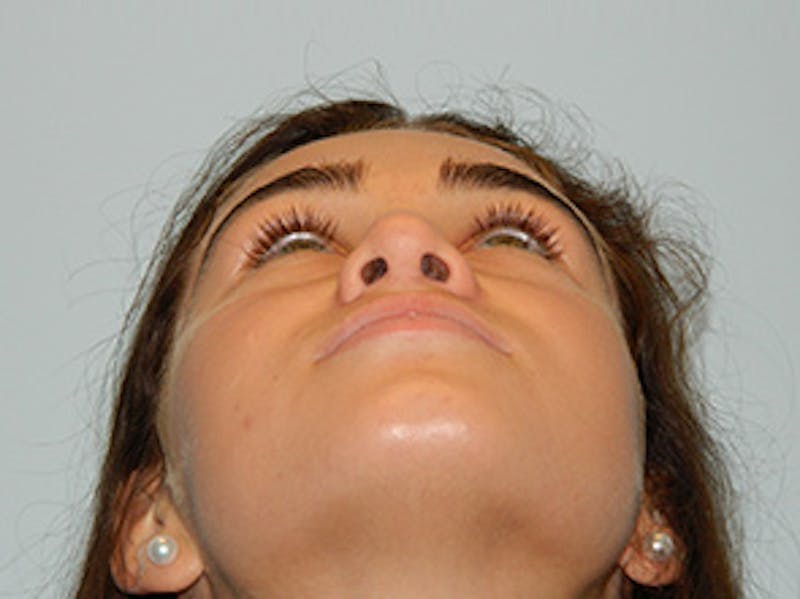 Rhinoplasty Before & After Gallery - Patient 133066706 - Image 6