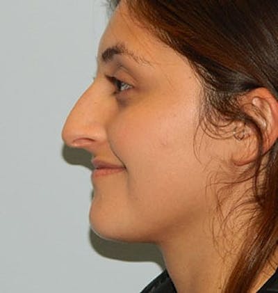 Rhinoplasty Before & After Gallery - Patient 133066710 - Image 1