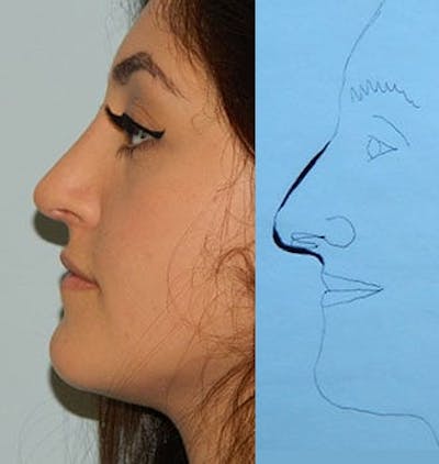 Rhinoplasty Before & After Gallery - Patient 133066710 - Image 2