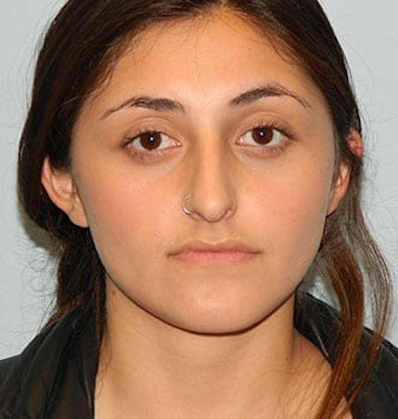 Rhinoplasty Before & After Gallery - Patient 133066710 - Image 3