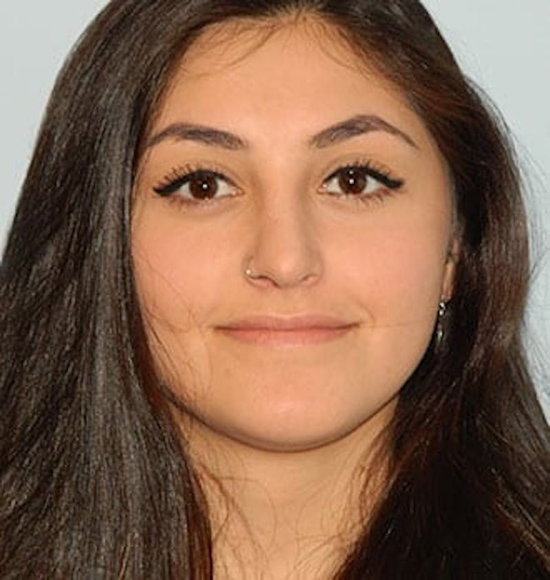 Rhinoplasty Before & After Gallery - Patient 133066710 - Image 4