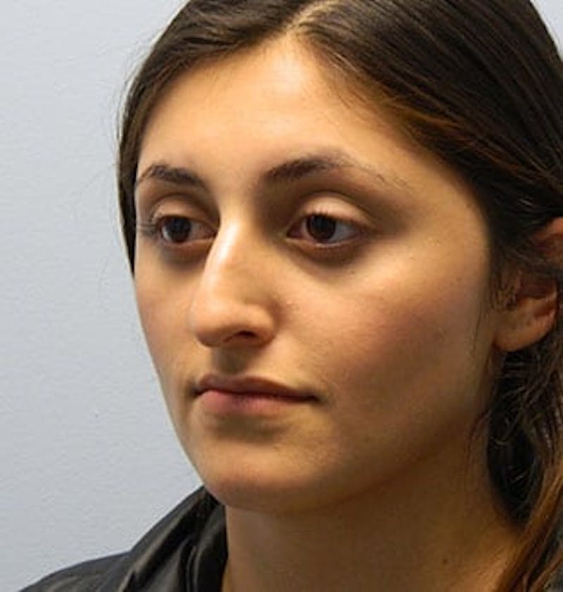 Rhinoplasty Before & After Gallery - Patient 133066710 - Image 5