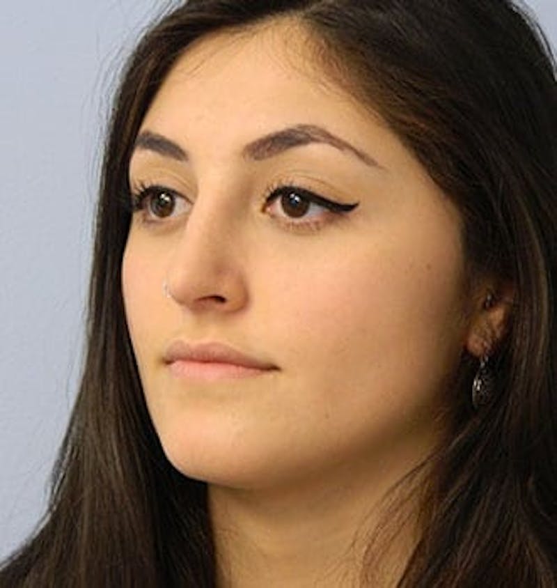 Rhinoplasty Before & After Gallery - Patient 133066710 - Image 6