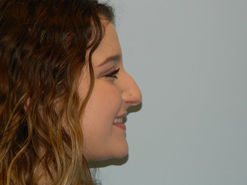 Rhinoplasty Before & After Gallery - Patient 133066712 - Image 1