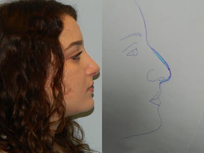 Rhinoplasty Before & After Gallery - Patient 133066712 - Image 2