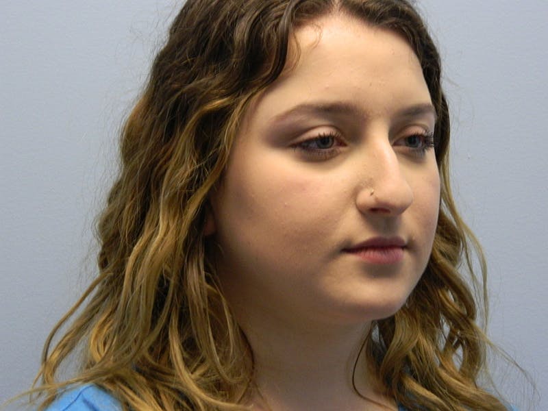 Rhinoplasty Before & After Gallery - Patient 133066712 - Image 3
