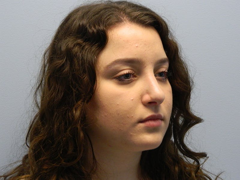 Rhinoplasty Before & After Gallery - Patient 133066712 - Image 4