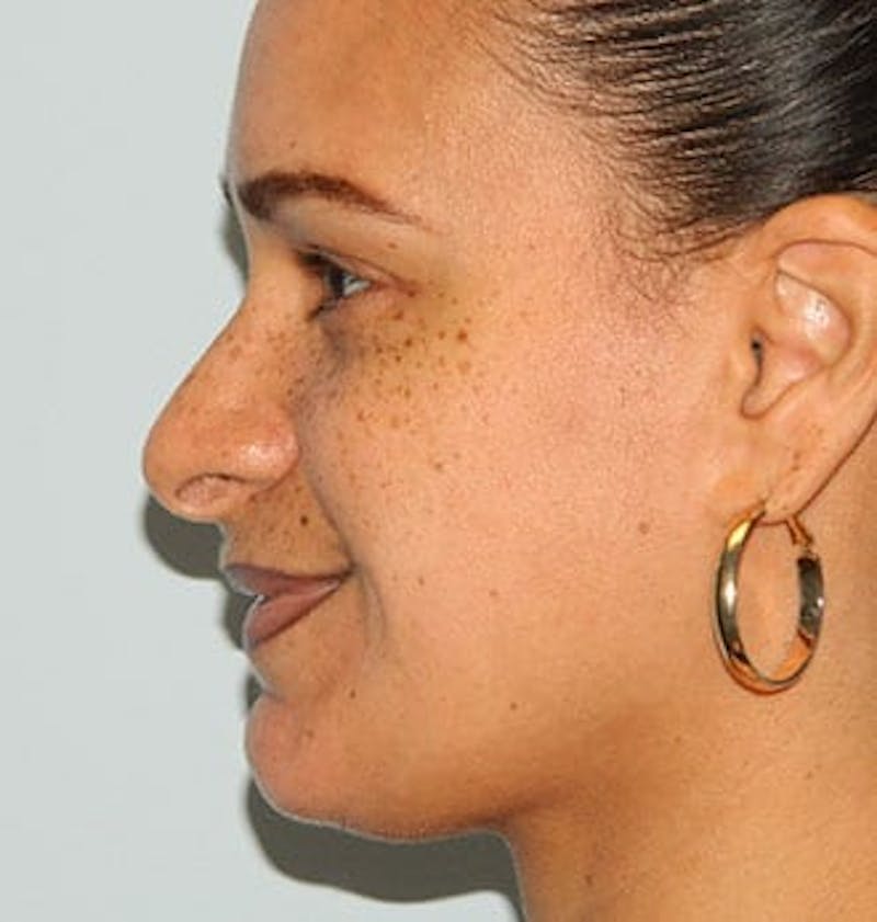 Rhinoplasty Before & After Gallery - Patient 133066713 - Image 1
