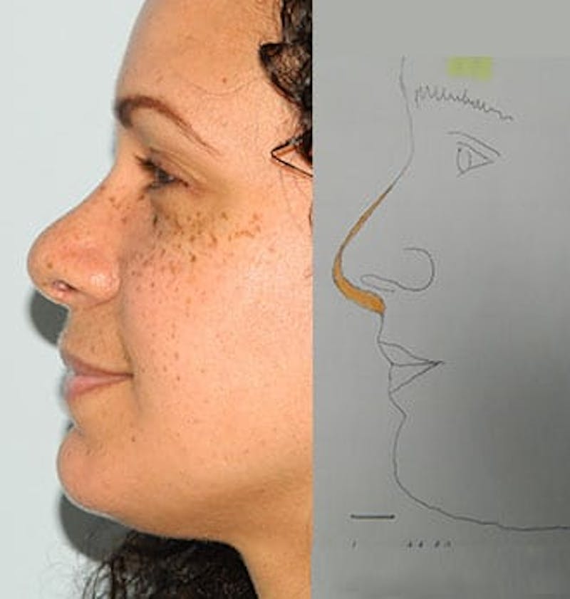 Rhinoplasty Before & After Gallery - Patient 133066713 - Image 2