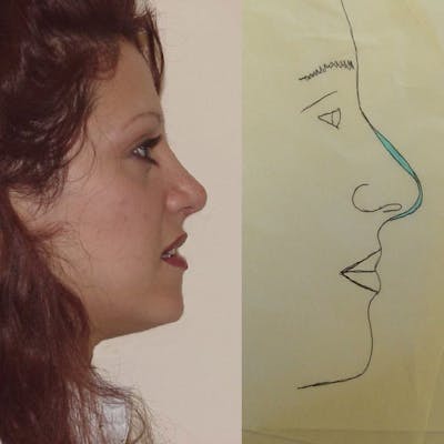 Rhinoplasty Before & After Gallery - Patient 133066714 - Image 2