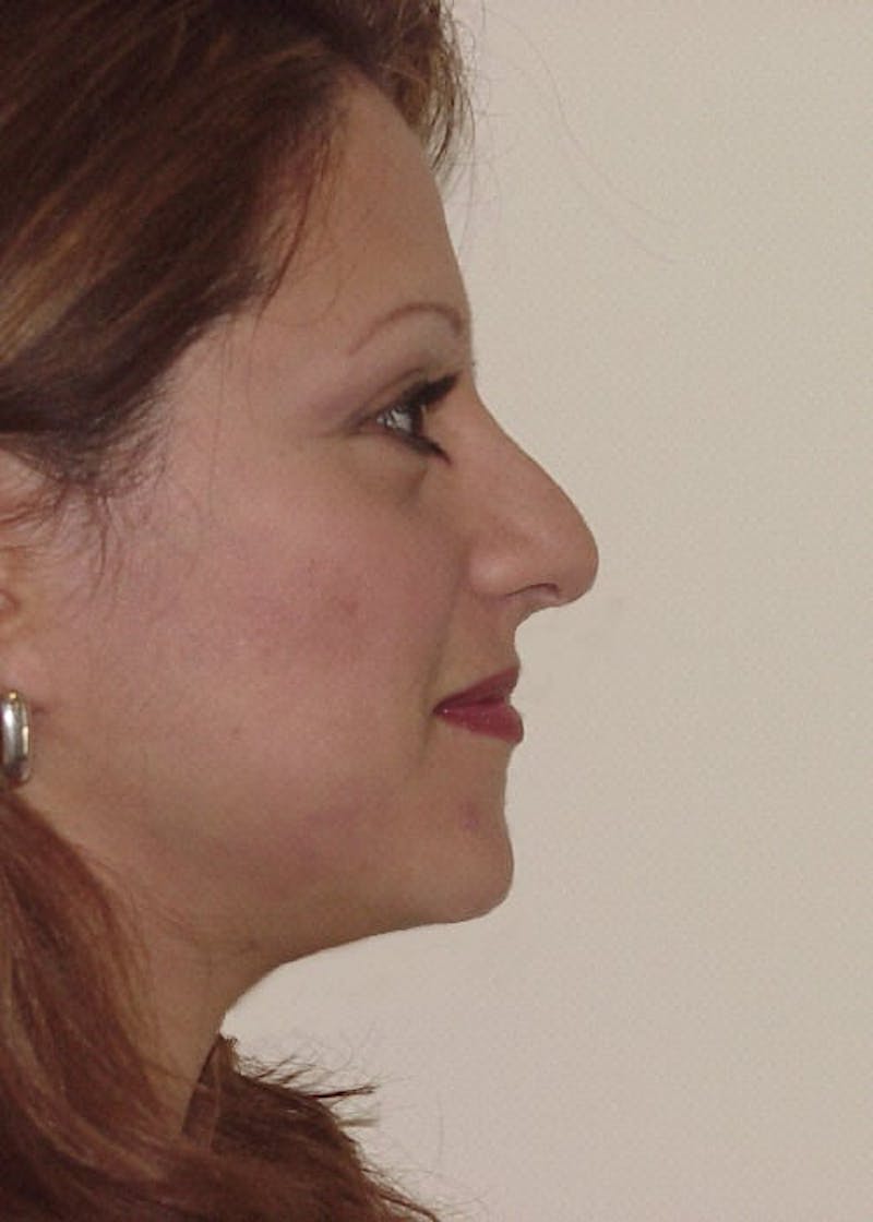 Rhinoplasty Before & After Gallery - Patient 133066714 - Image 3