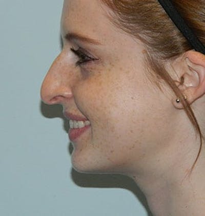 Rhinoplasty Before & After Gallery - Patient 133066715 - Image 1