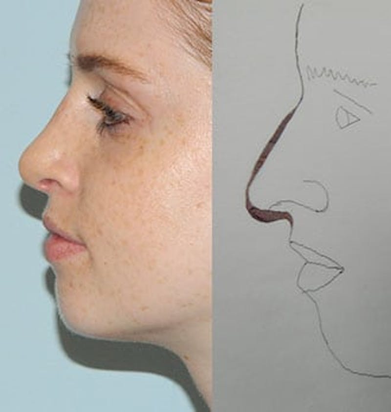 Rhinoplasty Before & After Gallery - Patient 133066715 - Image 2