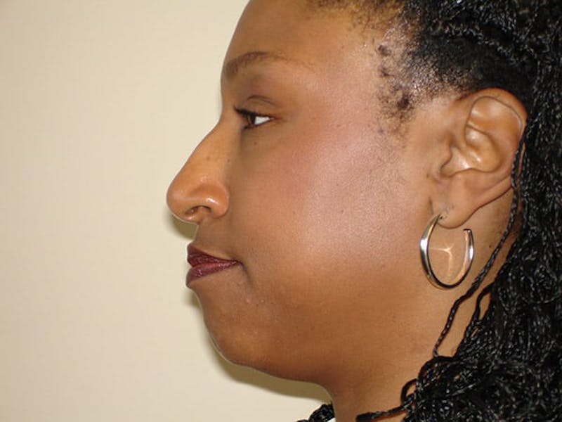 Rhinoplasty Before & After Gallery - Patient 133066716 - Image 1