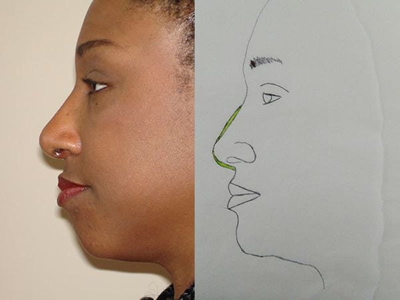 Rhinoplasty Before & After Gallery - Patient 133066716 - Image 2
